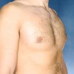 Gynecomastia Before & After Patient #8421