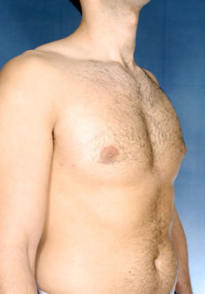 Gynecomastia Before & After Patient #8421