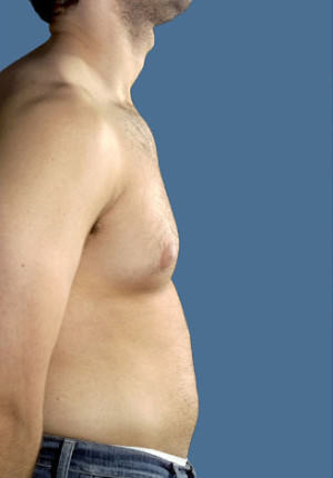 Gynecomastia Before & After Patient #8421