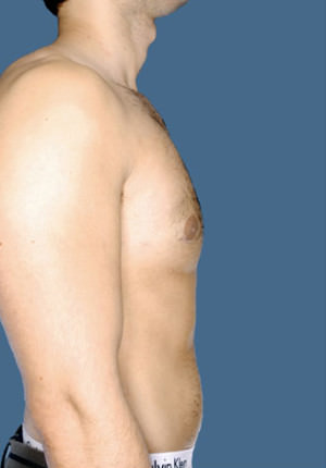 Gynecomastia Before & After Patient #8421