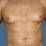 Gynecomastia Before & After Patient #8427