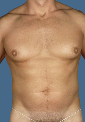 Gynecomastia Before & After Patient #8427