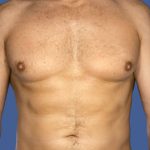 Gynecomastia Before & After Patient #8427