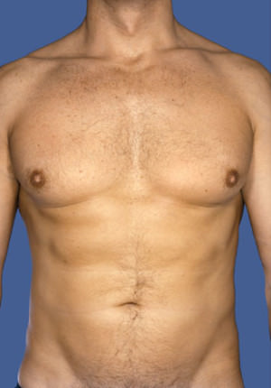 Gynecomastia Before & After Patient #8427