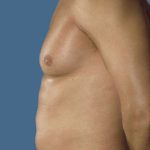 Gynecomastia Before & After Patient #8427