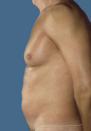 Gynecomastia Before & After Patient #8427