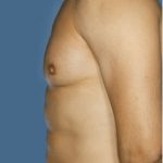 Gynecomastia Before & After Patient #8427