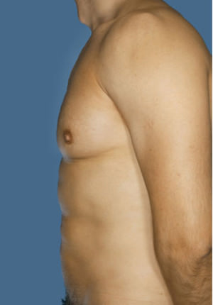 Gynecomastia Before & After Patient #8427