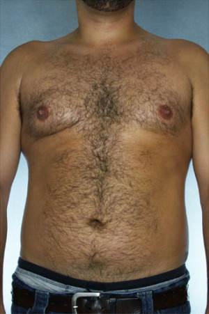 Liposuction Before & After Patient #8669