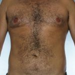 Liposuction Before & After Patient #8669