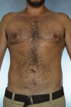 Liposuction Before & After Patient #8669