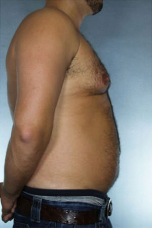 Liposuction Before & After Patient #8669
