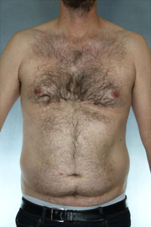 Liposuction Before & After Patient #8674