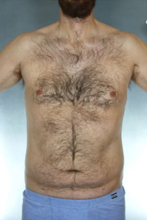 Liposuction Before & After Patient #8674