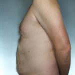 Liposuction Before & After Patient #8674