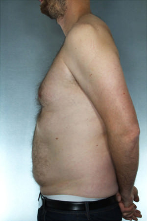 Liposuction Before & After Patient #8674