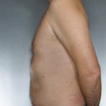 Liposuction Before & After Patient #8674