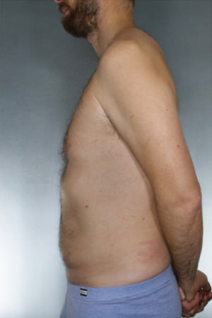 Liposuction Before & After Patient #8674