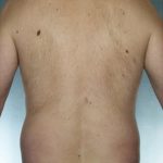 Liposuction Before & After Patient #8674