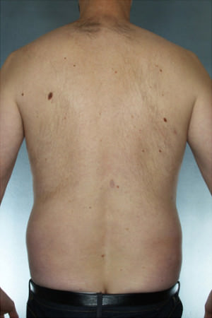 Liposuction Before & After Patient #8674