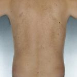 Liposuction Before & After Patient #8674