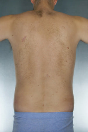 Liposuction Before & After Patient #8674