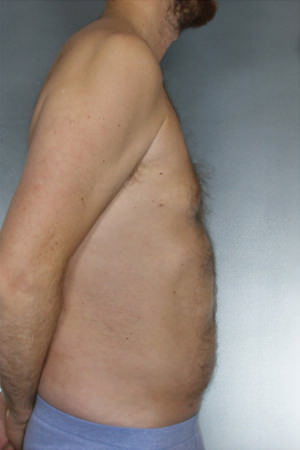 Liposuction Before & After Patient #8674