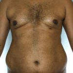 Liposuction Before & After Patient #8683