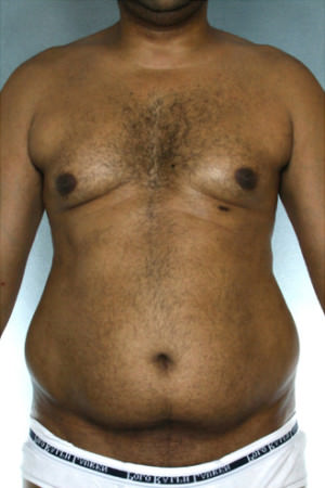 Liposuction Before & After Patient #8683