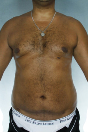 Liposuction Before & After Patient #8683