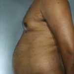 Liposuction Before & After Patient #8683