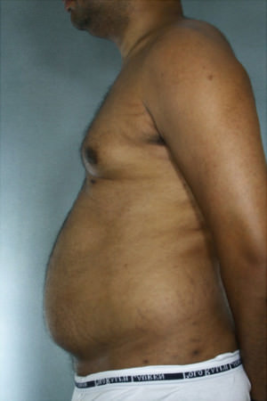 Liposuction Before & After Patient #8683