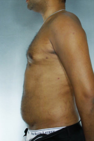 Liposuction Before & After Patient #8683