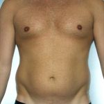 Liposuction Before & After Patient #8690