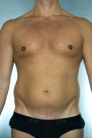 Liposuction Before & After Patient #8690