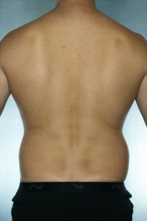 Liposuction Before & After Patient #8690