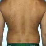 Liposuction Before & After Patient #8690