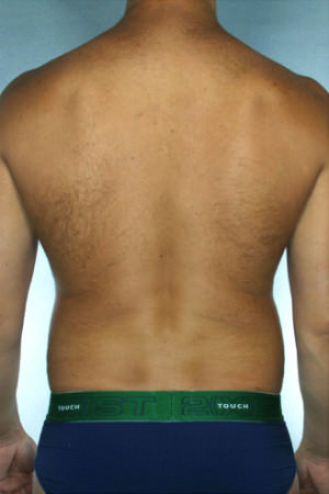 Liposuction Before & After Patient #8690