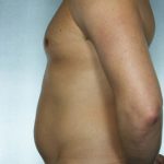 Liposuction Before & After Patient #8690