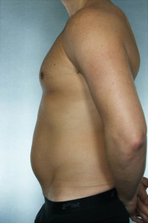 Liposuction Before & After Patient #8690