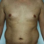 Liposuction Before & After Patient #8697