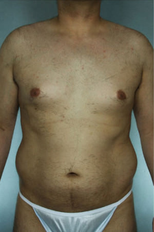 Liposuction Before & After Patient #8697