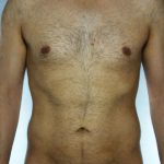 Liposuction Before & After Patient #8697