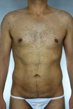 Liposuction Before & After Patient #8697