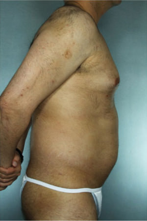Liposuction Before & After Patient #8697