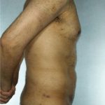 Liposuction Before & After Patient #8697