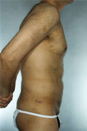 Liposuction Before & After Patient #8697