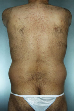 Liposuction Before & After Patient #8697