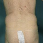 Liposuction Before & After Patient #8704