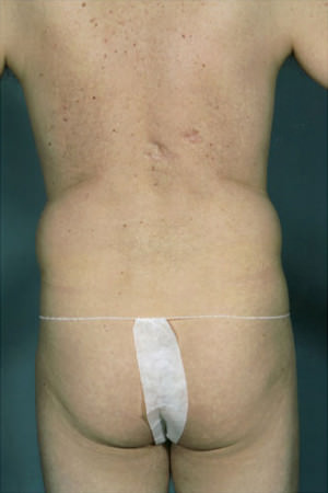 Liposuction Before & After Patient #8704